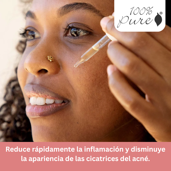 Tratamiento para Acné de Té de Árbol (0.34 fl oz 10 ml), 100% Pure